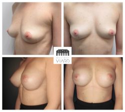 Augmentation mammaire par implants , protheses, Lyon
