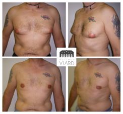 Gynecomastie, Operation mammaire chez l'homme, Lyon