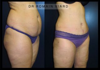 Lipoaspiration, Lipousccion, Avant Apres, Resultat