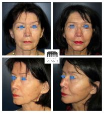 Lifting cervico facial, Lyon, Dr Romain Viard