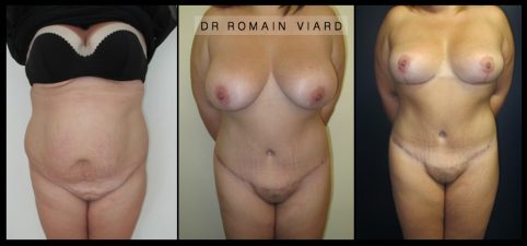 Avant Après, Réduction mammaire et Abdominoplastie, Chirurgie plastique, Lyon