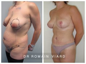 Mastopexie, abdominoplastie, liposuccion