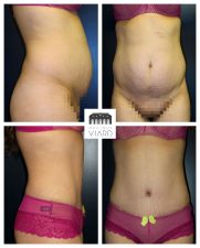 Resultat d'une abdominoplastie et liposuccion / lipoaspiration des hanches, Lyon