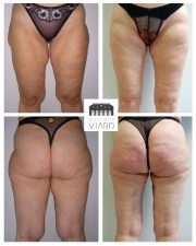Cruroplastie : lifting des cuisses, Chirurgie plastique a Lyon