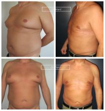 Avant apres resultat Gynecomastie Lyon