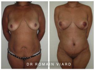 Resultat Lipofilling mammaire et abdominoplastie, Lyon