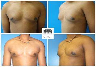 Resultat de la Gynecomastie, Avant Apres