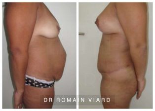 Abdominoplastie et Lipofilling mammaire a Lyon