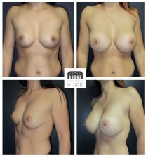 Augmentation mammaire, Chirurgie plastique Lyon