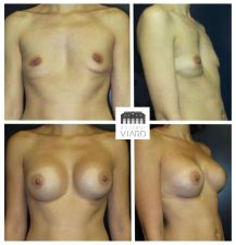 implants mammaires et lipofilling a Lyon, Avant Apres