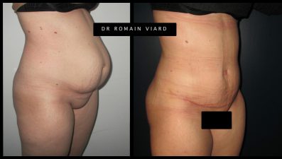 Abdominoplastie resultat avant apres, Lyon