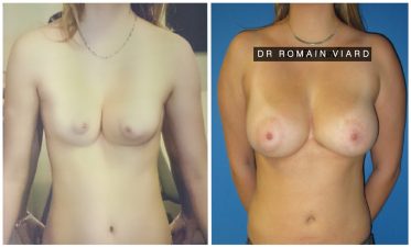 Lipofilling mammaire naturel, Chirurgie plastique a Lyon