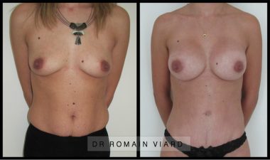 Augmentation mammaire par implants ronds, Chirurgie mammaire Lyon