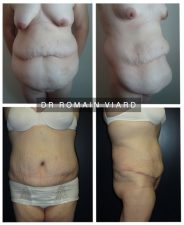 Abdominoplastie, chirurgie bariatrique a Lyon