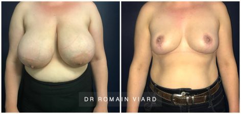 Dr Viard - Reduction mammaire, Resultat