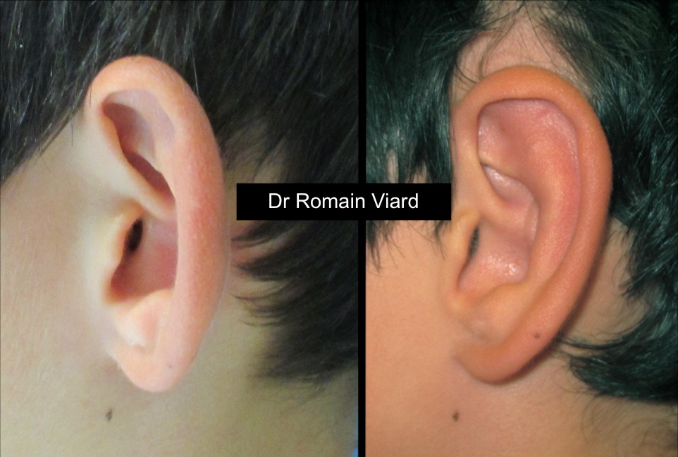 Otoplastie Chirurgie Esthetique A Lyon Dr Romain Viard