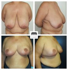 Chirurgie plastique a Lyon, Reduction mammaire