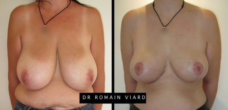 Reduction mammaire a Lyon, Dr Viard