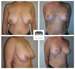 Hypertrophie mammaire seins de volume excessif