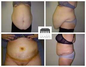 Abdominoplastie