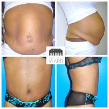 Abdominoplastie, Diastasis, Lyon, avant apres