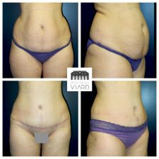 Abdominoplastie, lipoaspiration des hanches, Lyon