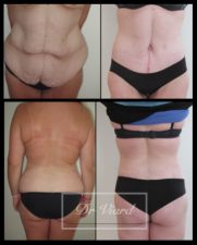 une jeune femme, bodylift, avant apres