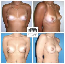 Avant apres, Resultat, Augmentation mammaire par implants mammaires, Lyon