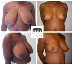 Réduction mammaire, poitrine, gros seins, Dr Viard