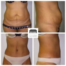 Liposuccion et Abdominoplastie Lyon