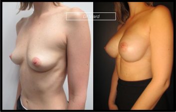 Augmentation mammaire Lyon : implants et protheses mammaires