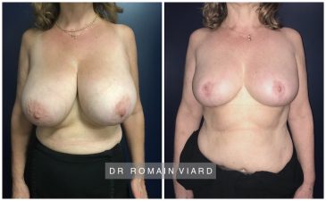 Reduction mammaire Dr Viard, Lyon