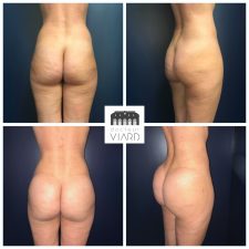 Brazilian Buttock lift (lipostructure des fesses), Dr Viard