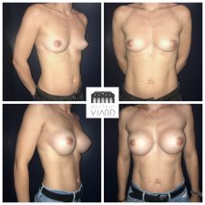 Résultat implants mammaires, 300cc NAGOR
