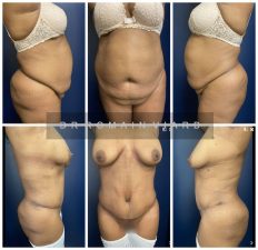 Abdominoplastie chez une Femme de 50 ans.