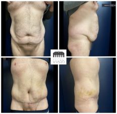 Abdominoplastie chez un homme