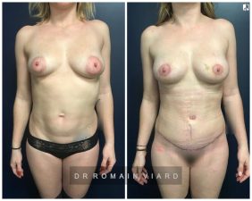 Abdominoplastie et mastopexie par round block et lipostructure mammaire.