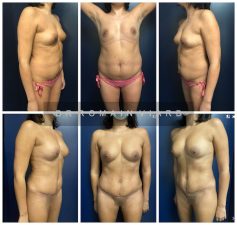 Abdominoplastie et mastopexie par round block et lipostructure mammaire.