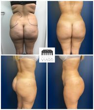 BBL Brazilian buttock lift