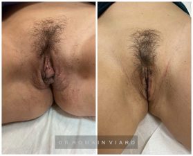 hypertrophie des petites lèvres génitales